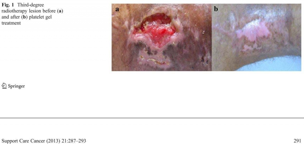 PRP凝膠可用於放射性皮膚炎的治療