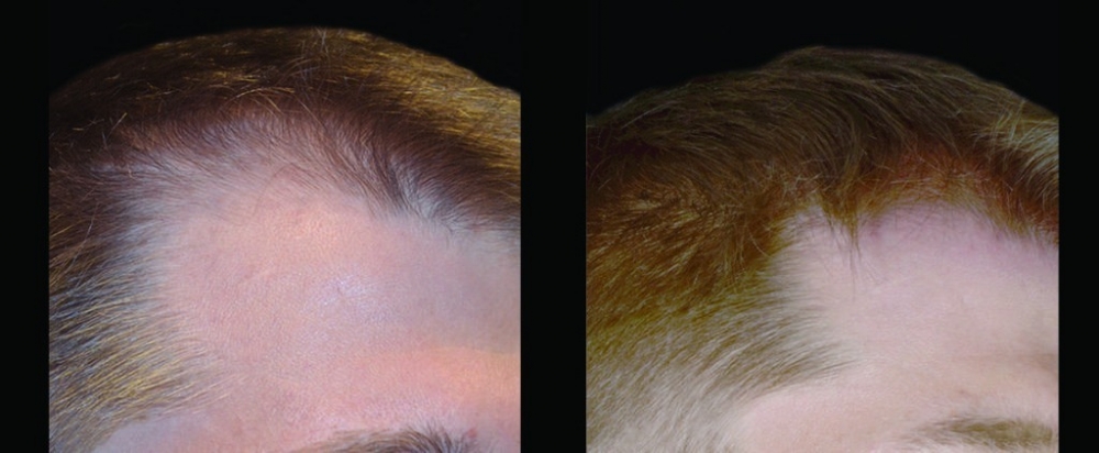 PRP在皮膚病學中有許多應用- 1. 頭髮修復