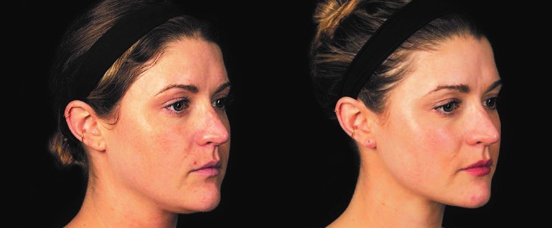 PRP在皮膚病學中有許多應用- 2. 皮膚年輕化